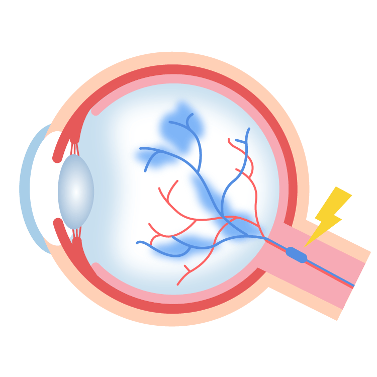 網膜静脈閉塞症イメージ